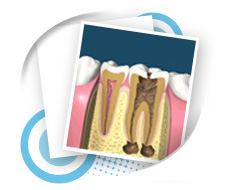 Endodontic Dental Service