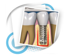 Dental Implant