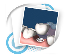 Prosthodontics Dental Service